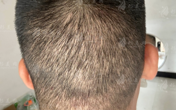 植發(fā)加密多少錢一個(gè)單位？會(huì)損傷原有頭發(fā)嗎？