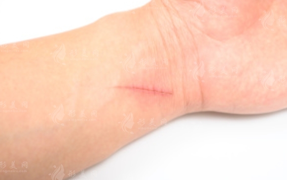 激光祛疤痕：價格與效果揭秘