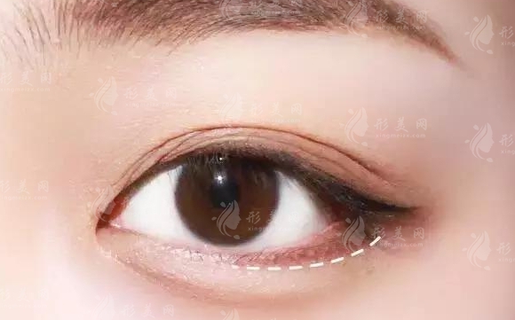 膠原蛋白豐臥蠶：消腫時間與材料副作用解析