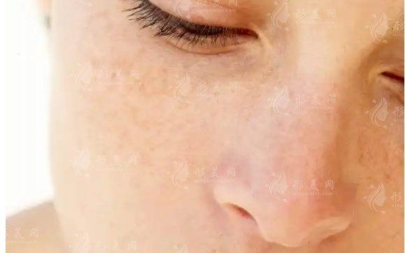 激光祛斑后如何快速修復與有效護理