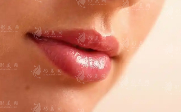 厚唇改?。夯謴蜁r間與手術風險全解析