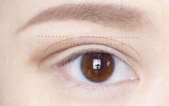 雙眼皮修復(fù)：方法、必要性及適用情況