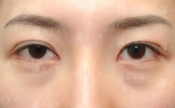 內(nèi)切祛眼袋：長(zhǎng)期效果與復(fù)發(fā)可能性探討