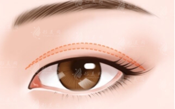 雙眼皮手術(shù)后熱敷會(huì)加重疤痕增生嗎？