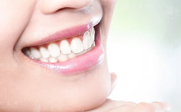 烤瓷牙一般費用及適用性分析