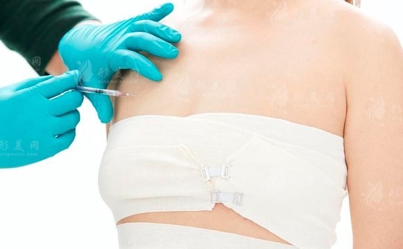 假體隆胸切口及假體填充位置介紹
