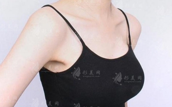 假體隆胸手術(shù)失敗修復(fù)難度高嗎？恢復(fù)時間長不長？