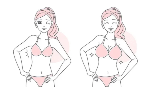 抽脂肪隆胸：可選部位與術后護理