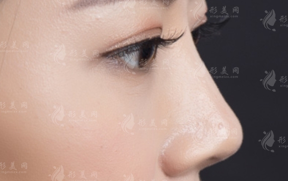 鼻子皮膚薄適合做硅膠假體隆鼻嗎？