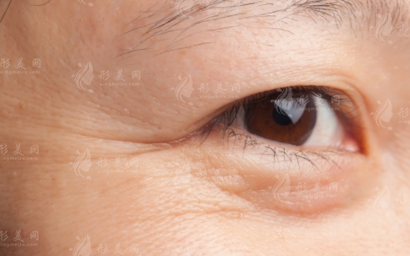 打眼部去皺針會(huì)傷害到眼睛嗎？