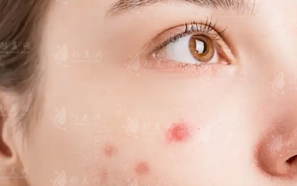 微針治療：多久做一次才合適？微針去痘坑又該如何安排？