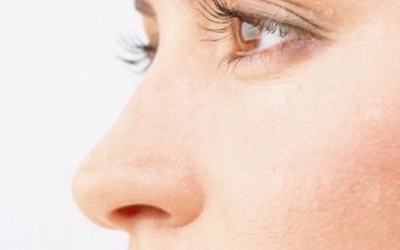 低鼻尖整形手術(shù)：鼻尖抬高必須要用軟骨嗎？