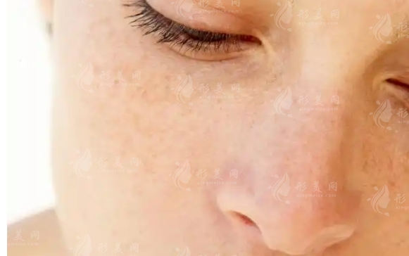 疤痕體質(zhì)可以做彩光祛斑嗎？疤痕體質(zhì)快來(lái)看看吧！