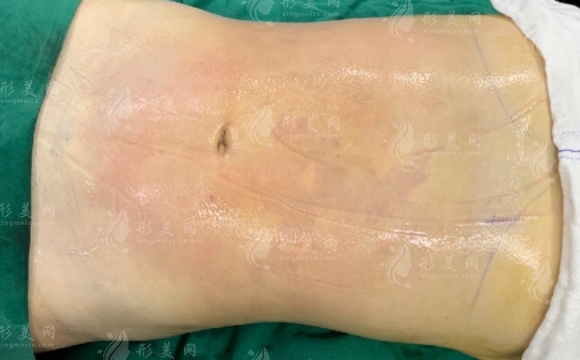 腹部脂肪抽吸整形：了解風(fēng)險(xiǎn)與預(yù)防措施