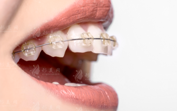 北京諾美口腔2026收費(fèi)價(jià)目表曝光！6店通用/種植牙4988起/矯正8800起