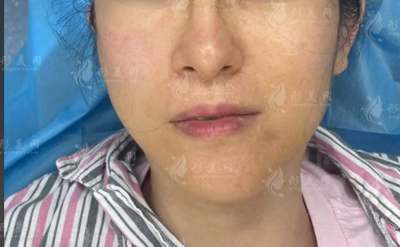 上海王洪醫(yī)生靠譜嗎?生長因子奧美定修復(fù)技術(shù)全揭秘