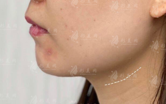 武漢下頜緣提升哪家好？3家醫(yī)院輪廓針實(shí)測對比