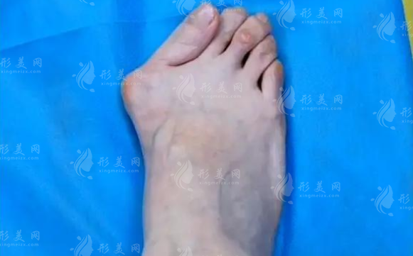 2026蘇敬達(dá)微創(chuàng)大腳骨價格曝光，北京圣嘉新親診預(yù)約攻略