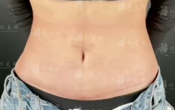 成都腹壁整形選誰好?劉亞平vs李獻和技術口碑大比拼