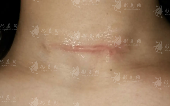 廣州祛疤醫(yī)院哪家好?排名前五正規(guī)醫(yī)院醫(yī)生名單出爐