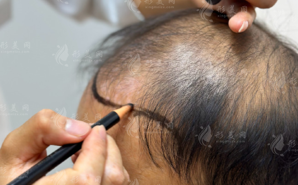 廣州植發(fā)醫(yī)院哪家好?排名前十名單+醫(yī)生推薦+價(jià)格表