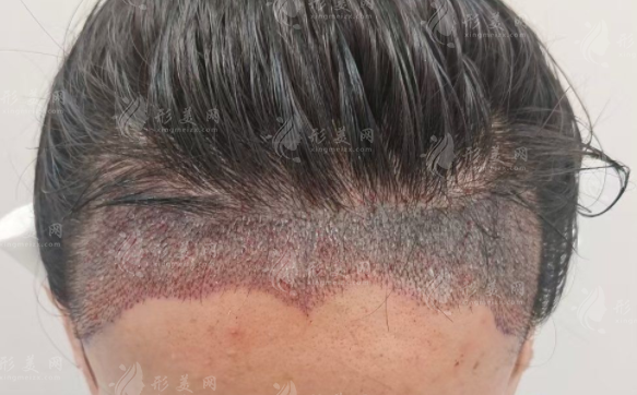 廣州植發(fā)醫(yī)院哪家好?這三家技術(shù)靠譜口碑公認(rèn)