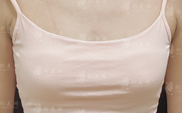 打了20年的豐胸針現(xiàn)在慌不慌?這3個(gè)隱患比癌變更嚇人