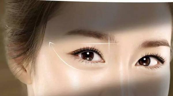 重瞼修復(fù)術(shù)的恢復(fù)時間要多久