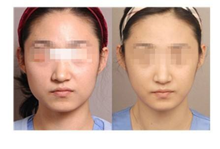 瘦臉針只對(duì)咬肌肥大才有效果嗎