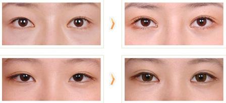 開外眼角多少錢