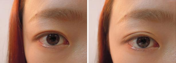 歐式雙眼皮禁忌人群