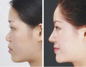 隆鼻手術(shù)有哪些注意事項