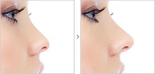 鼻尖整形注意事項