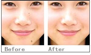 嘴角上揚術后注意事項