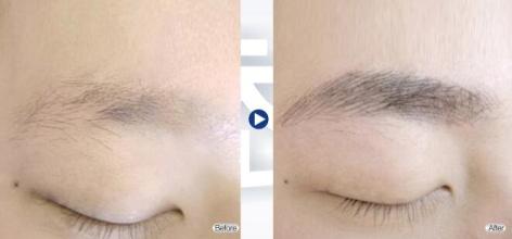 眉毛整形術(shù)后注意事項