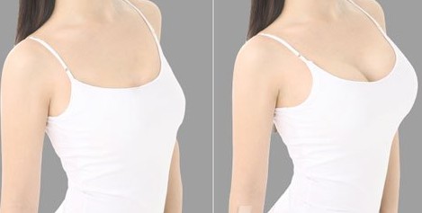 假體豐胸價(jià)格