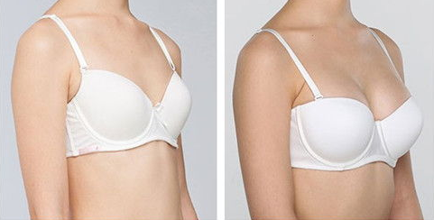 自體脂肪豐胸