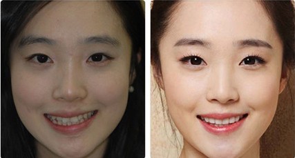 地包天矯正適合哪個(gè)年齡段