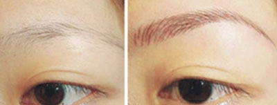 眉毛移植對比圖