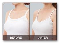 巨乳縮小手術(shù)適應(yīng)癥