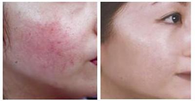 光子去紅血絲注意事項(xiàng)