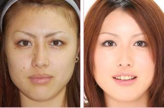 激光祛黑色素注意事項(xiàng)