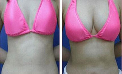 假體豐胸存在哪些隱患