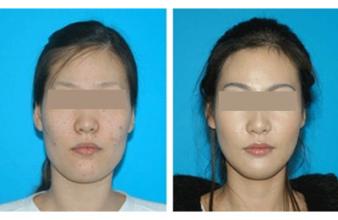 激光去色素多少錢