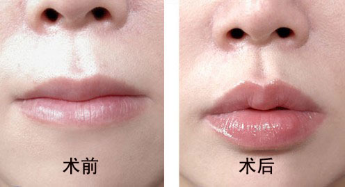 豐唇術(shù)后護(hù)理有哪些