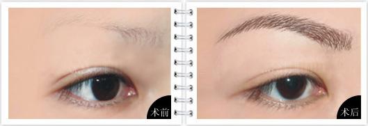 眉毛種植對比照
