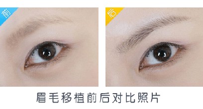 眉毛種植對比照