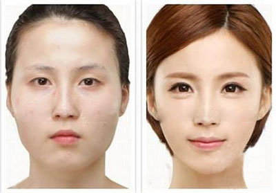 上瞼松弛整形手術(shù)有哪些方法