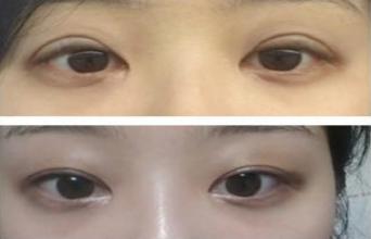 眼部失敗修復(fù)術(shù)適應(yīng)癥