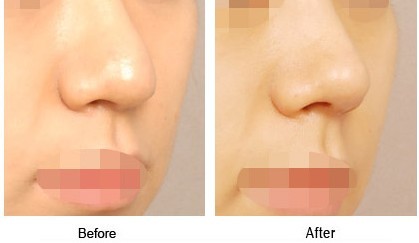 鼻尖整形價(jià)格是多少